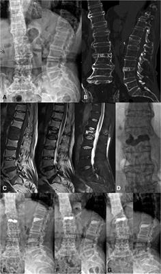 Percutaneous kyphoplasty for the treatment of diffuse idiopathic skeletal hyperostosis with vertebral fractures: A case report and treatment review